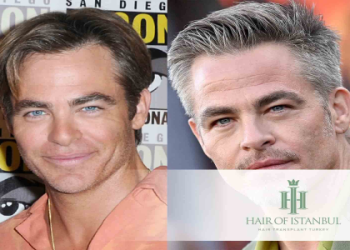 Connor McGregor Hair Transplant: Real or Fake? (We Investigate the UFC Stars Changing Hairline)